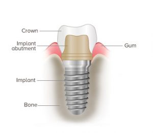 implant diagram